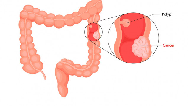imagen Cáncer de colon: 9 de cada 10 casos pueden curarse con un diagnóstico temprano